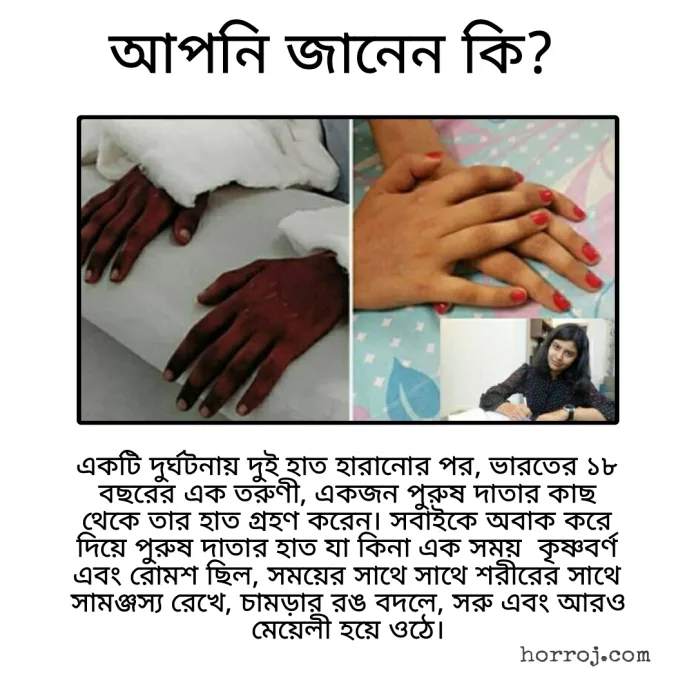 Transplanted hand, Did you know, horroj.com